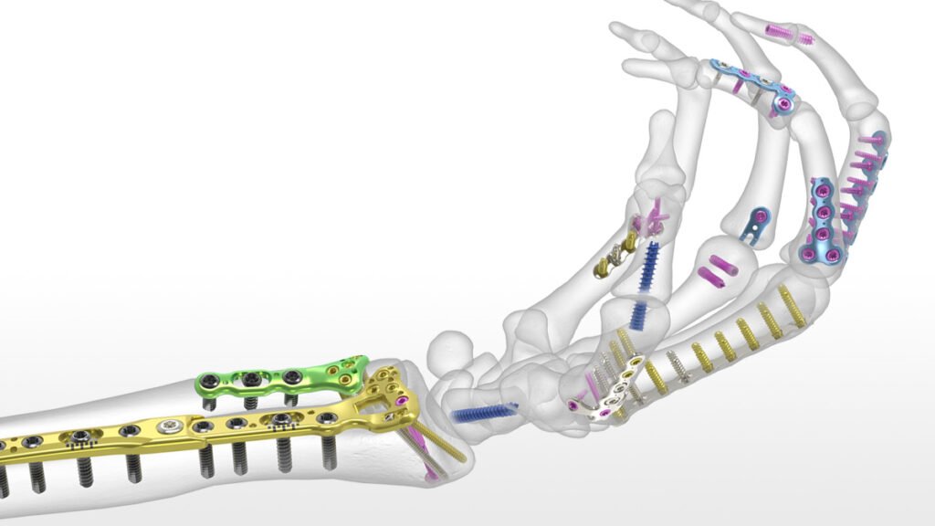 Como os portadores de placas ou pinos podem se beneficiar do PCD